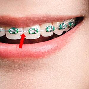 Braces Archwire