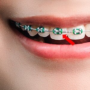 Braces Bracket