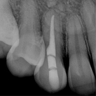 Root Canal Theraphy