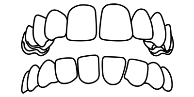 Gap-Teeth